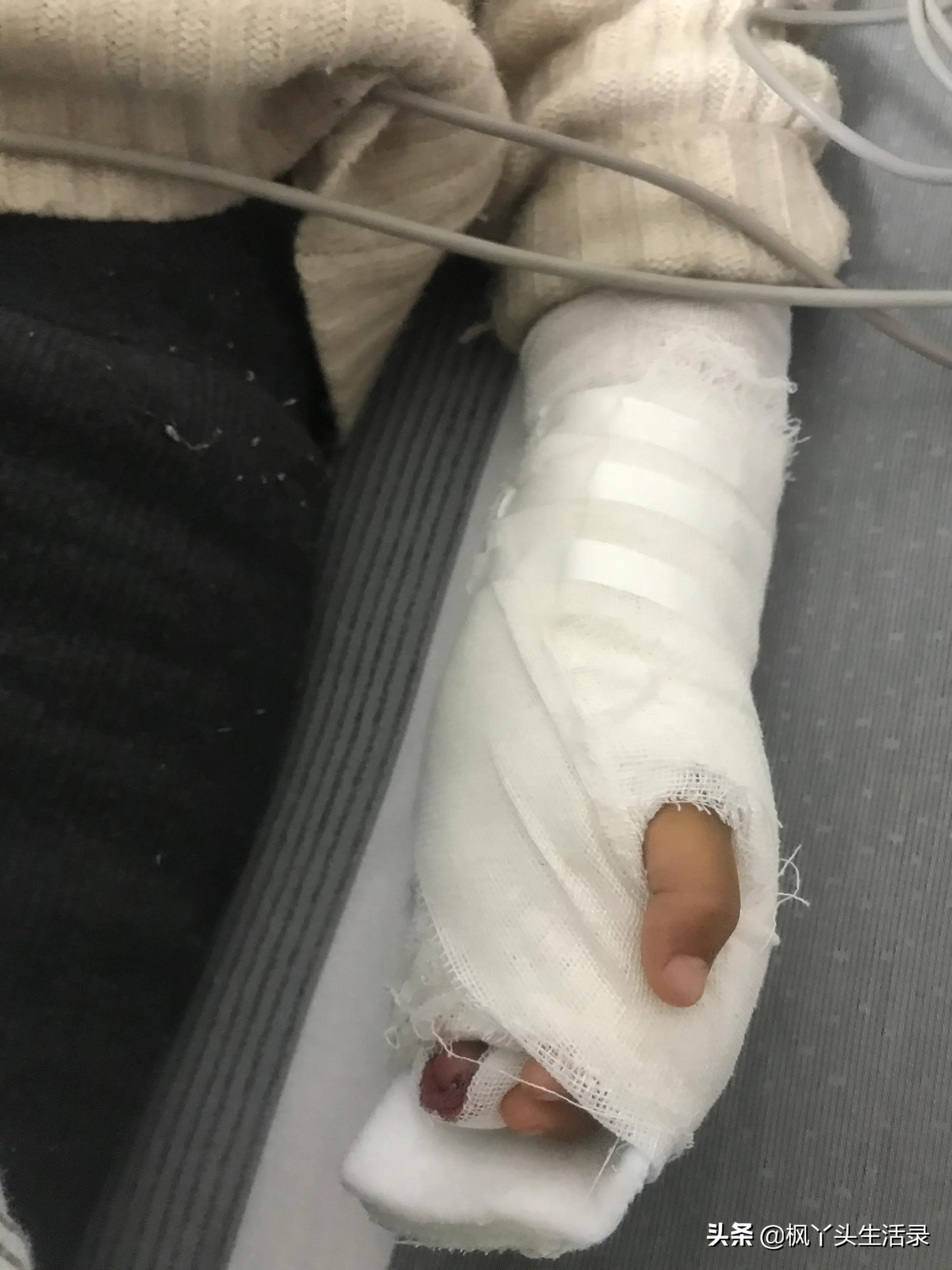 女儿手指被夹断了,梦到女儿手指头被夹断了