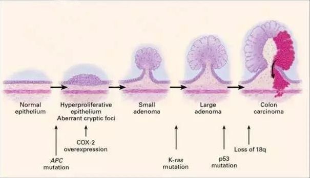 直肠癌手指能摸到肿块吗,直肠癌用手指能摸到吗
