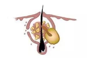 祛鼻头黑头最有效的方法,去黑头的错误做法