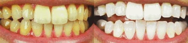 牙齿刷完白了过一会又黄了,牙齿涂氟涂一次大概多长时间