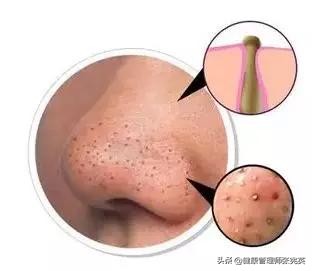 眼下长了好多小米粒怎么办,为什么会突然长出来很多小米粒