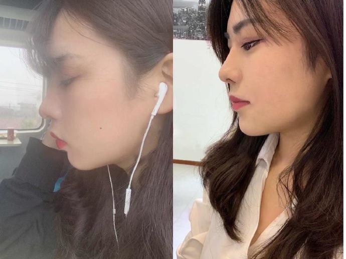 下巴什么假体可以避免骨吸收,假体隆下巴会割断唇系带吗