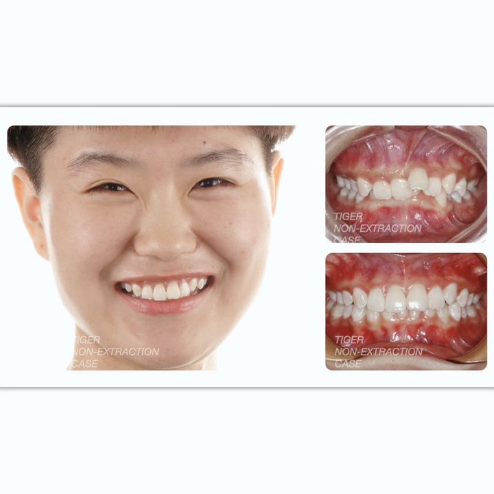 南京靠谱的牙齿矫正医院,南京省哪个医院牙齿矫正比较好