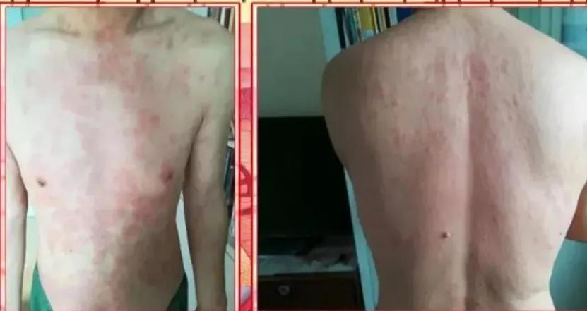 皮肤病反反复复要如何调理,皮肤病反反复复中药如何治疗