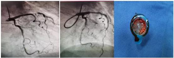 冠心病介入无植入还要长期吃药吗,冠心病介入无植入需要长期服药吗