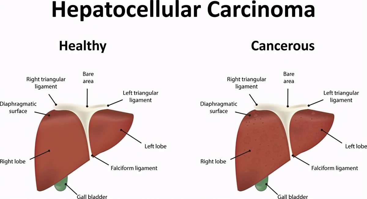 乙肝大三阳怎么了解自己严不严重,乙肝大三阳严重吗