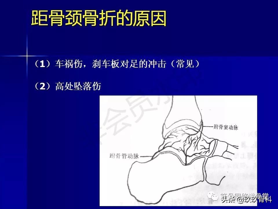 距骨骨折的治疗原则,距骨骨折如何调理