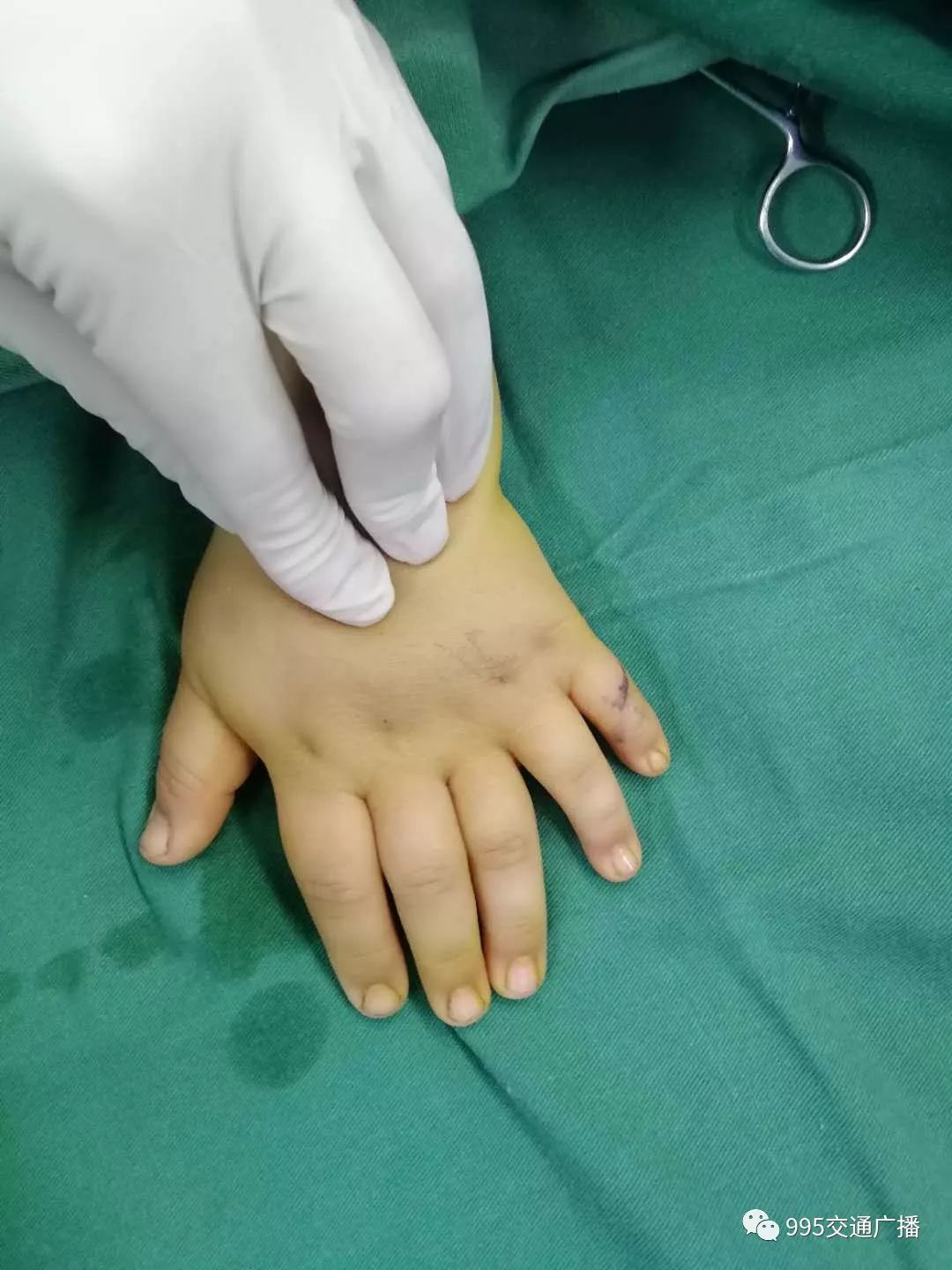 浏阳医院婴儿,小孩出生只有四根手指做手术