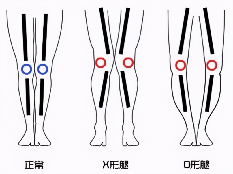膝关节骨软骨损伤什么原因,膝关节骨关节炎软骨退化康复训练
