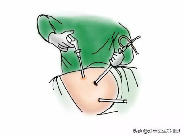 备孕医学科普试管移植,备孕医生为什么讲要调理三个月