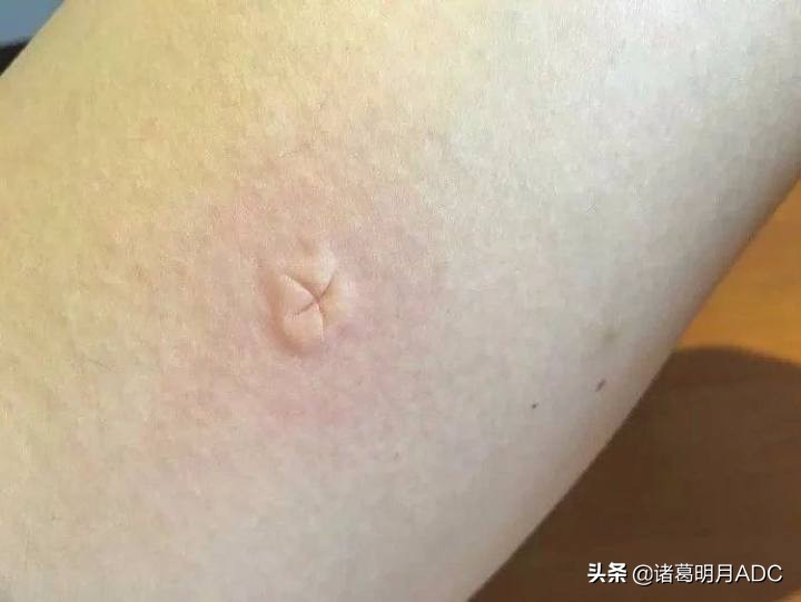 日本止痒液蚊虫叮咬止痒推荐,蚊虫叮咬止痒能用百草止痒膏吗