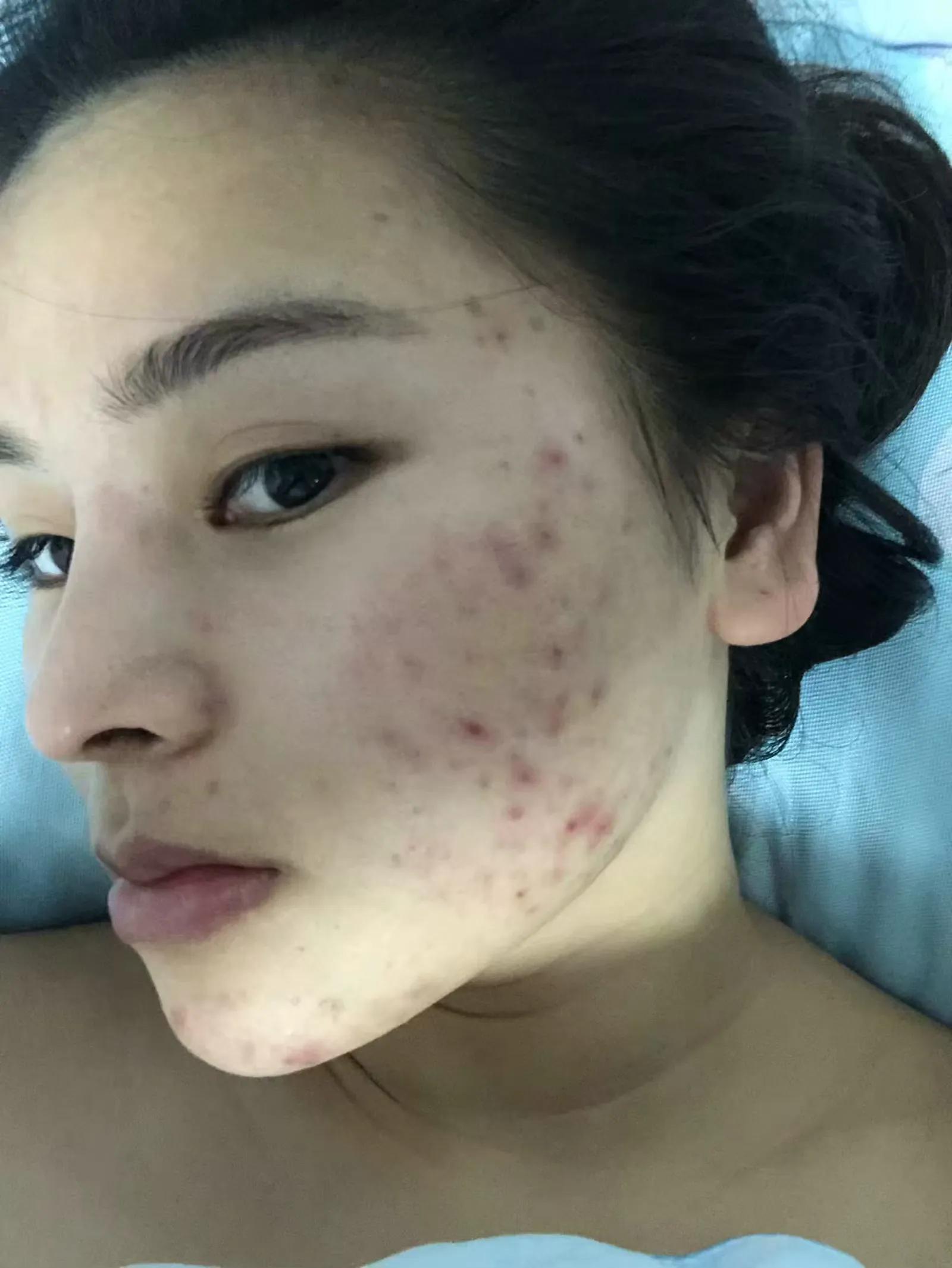 30天快速消痘印,30天祛痘效果最好的方法