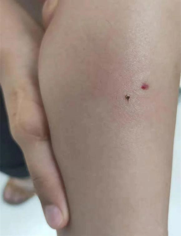 4岁孩子被蜜蜂咬了怎么办,孩子被蜜蜂蛰了妈妈很心疼
