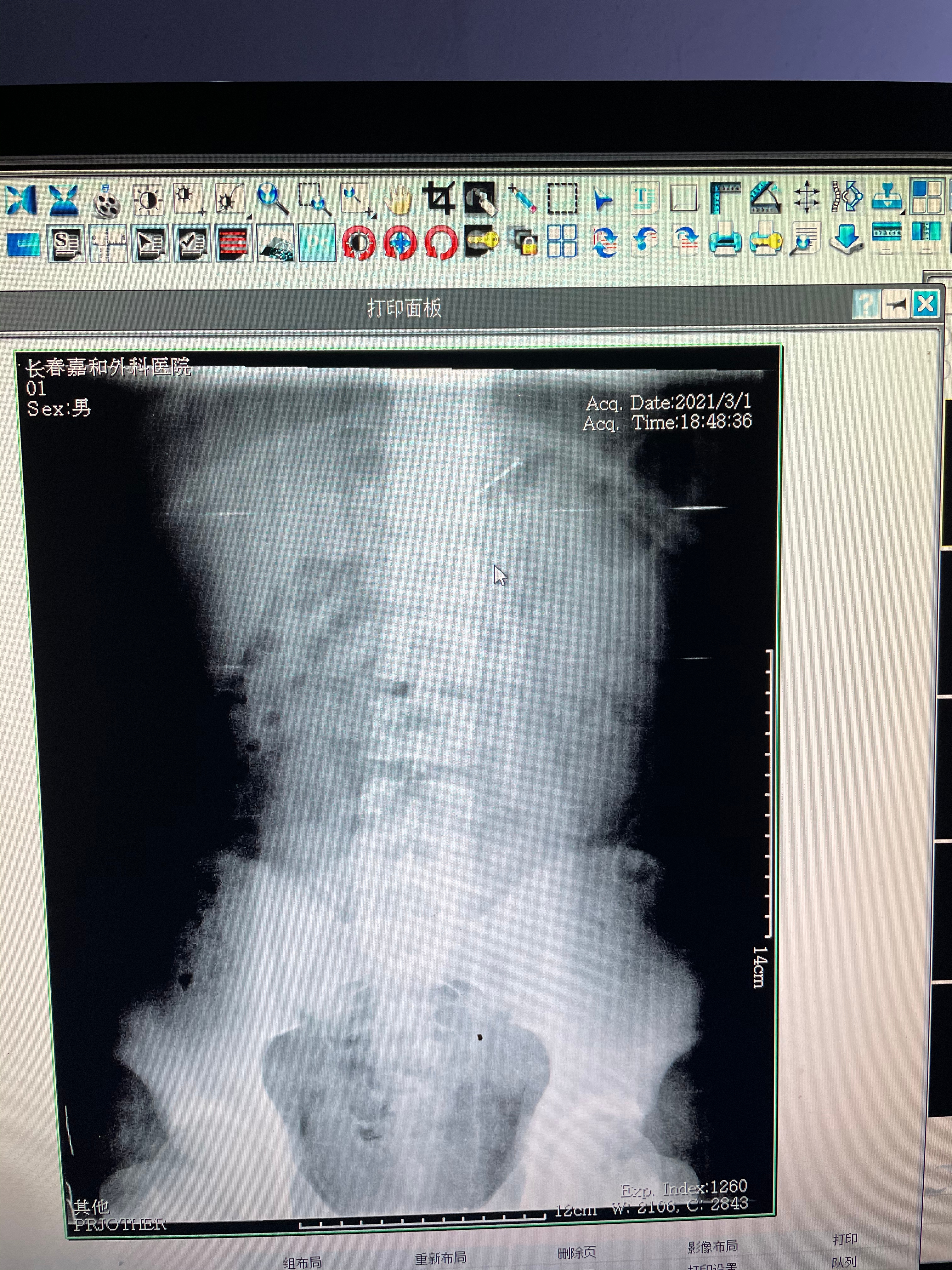 危险!长春13岁男孩把两根4厘米长钢钉含在嘴里玩不慎误吞