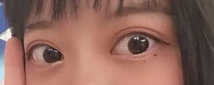 桥本氏甲亢多久转换成甲减,甲亢治疗中为什么会转为甲减