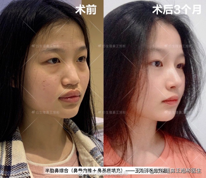 那些被鼻子“封印”颜值的鼻综合/修复案例|广州鼻整形