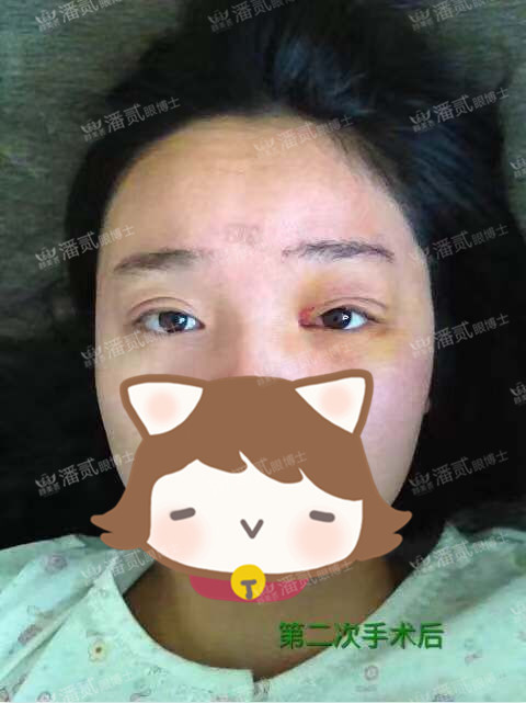 提肌矫正失败的表现眼皮睁不开,做完提肌眼睛前半段下垂