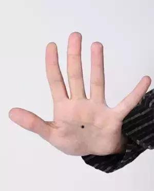 痣不能点的位置,哪几个位置的痣一定要去掉