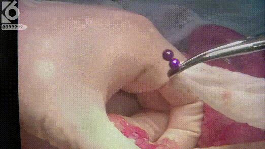 幼儿误吞磁力珠致小肠穿孔,女孩误吞磁力珠致6处肠穿孔