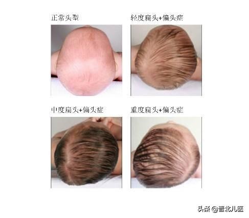 宝宝睡觉睡得偏头，还能补救吗？