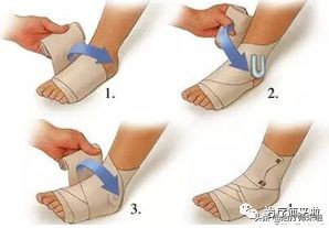 踝关节不稳康复训练,慢性踝关节不稳的运动康复修复