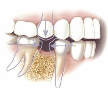 种植牙和烤瓷牙优缺点比较,种植牙和烤瓷牙的利与弊