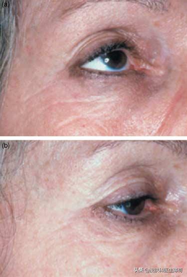 如何防止光老化氧化,预防光老化的最佳方法