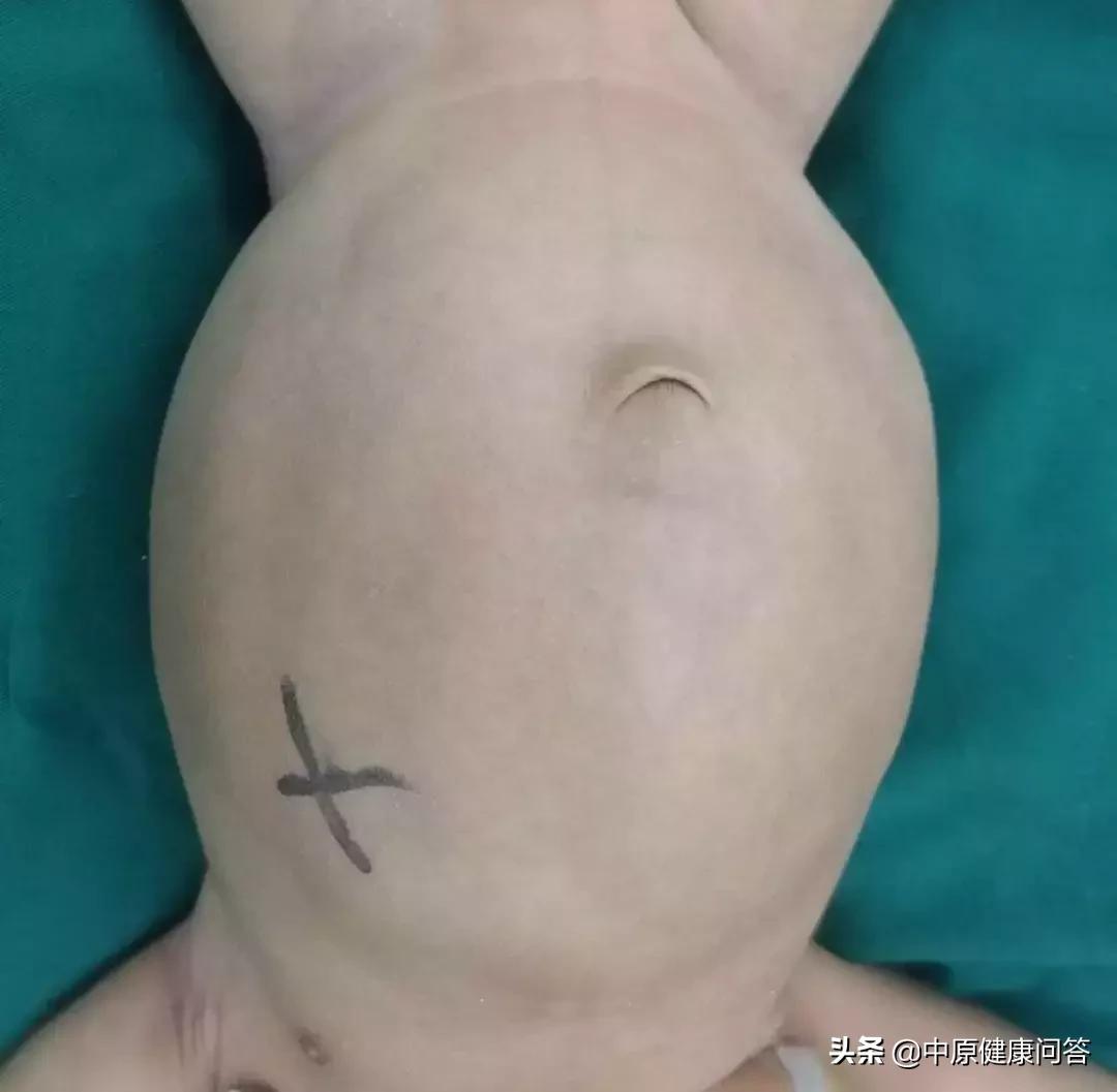 2个月宝宝泌尿系统畸形,小孩肚子肠子畸形会有什么特点