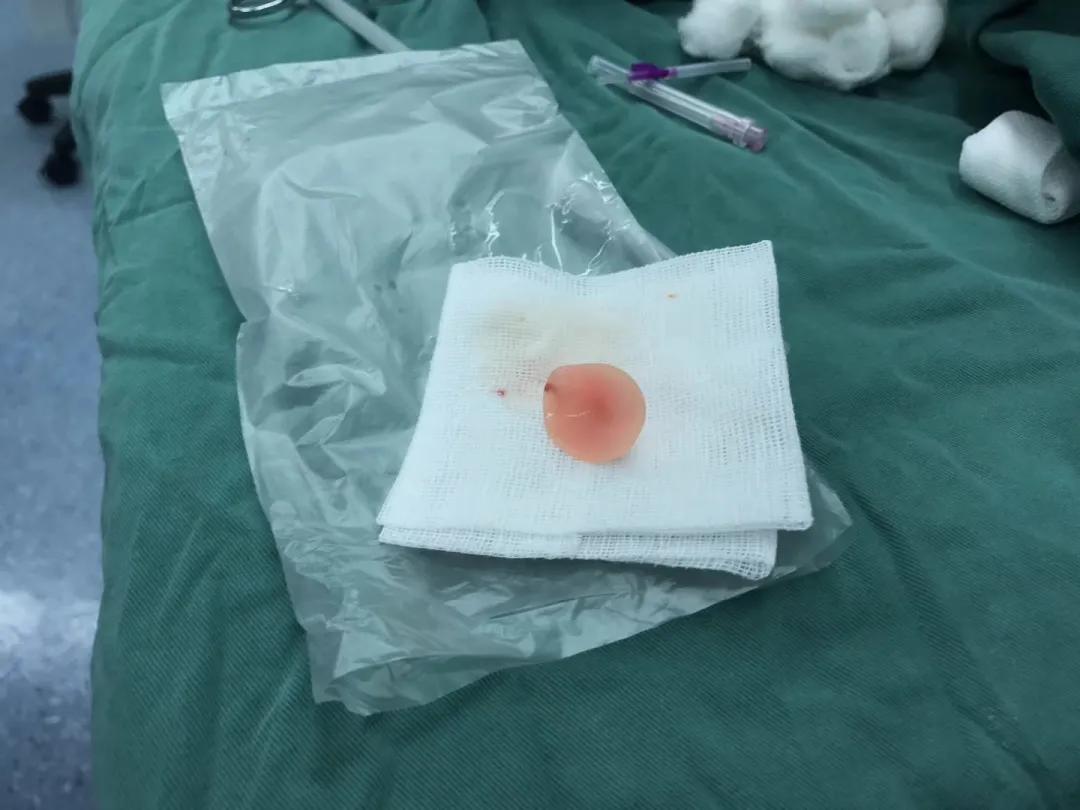 四岁小男孩往小丁丁里塞弹珠?那些年孩子塞进去的东西远不止这个