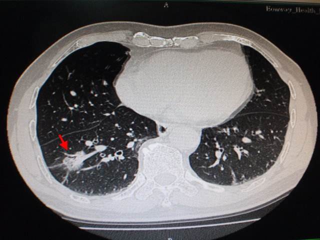 肺腺癌晚期抗癌故事,老人肺腺癌如果有咳嗽怎么办