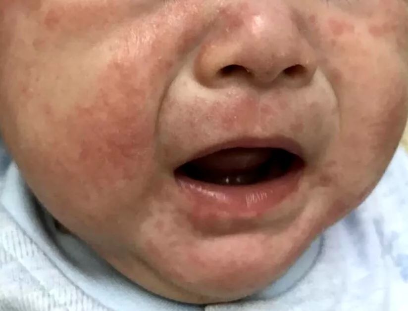 湿疹保湿是关键,保湿乳婴儿湿疹