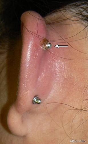 小孩的耳朵怎么护理,宝宝耳朵有异物医生怎么洗