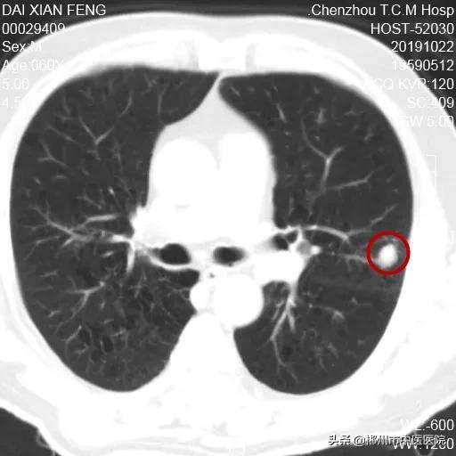肺癌陀螺刀放疗后五年生存率,得了肺癌是不是不要轻易动手术
