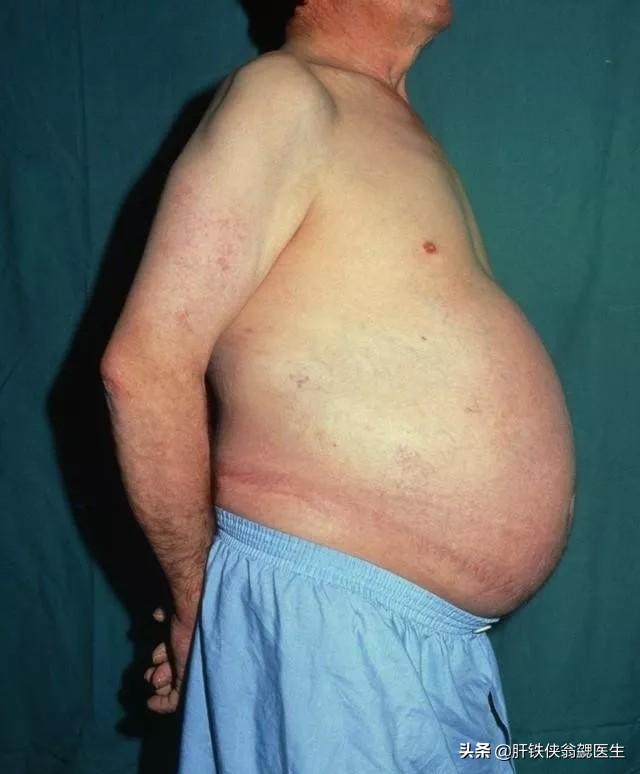 脾大会误诊吗,疑似脾大需要治疗吗