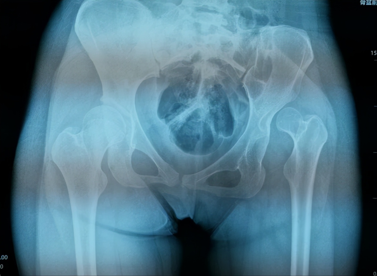 AI助力精准处理IV型髋关节发育不良花季少女翻开人生新篇章