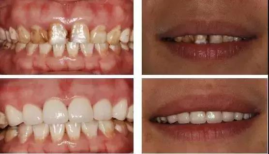怎么才能真正有效的美白牙齿,最快最有效美白牙齿的方法