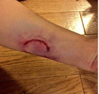 被猫咬出血要打狂犬疫苗吗,被仓鼠咬了要打狂犬疫苗吗