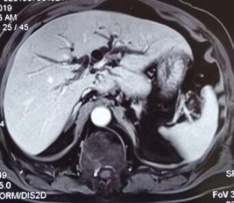 胆管癌不能手术如何治疗,胆管癌为什么不能做手术