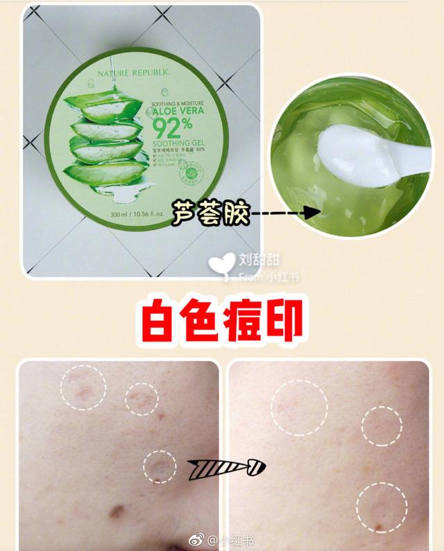 身上的痘痘跟痘印该怎么去除,祛除痘痘和痘印最快方法