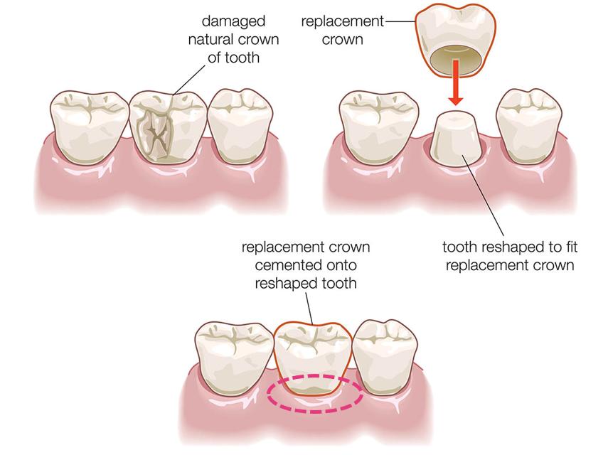 冷光美白牙齿危害亲身经历,牙齿美白科普篇