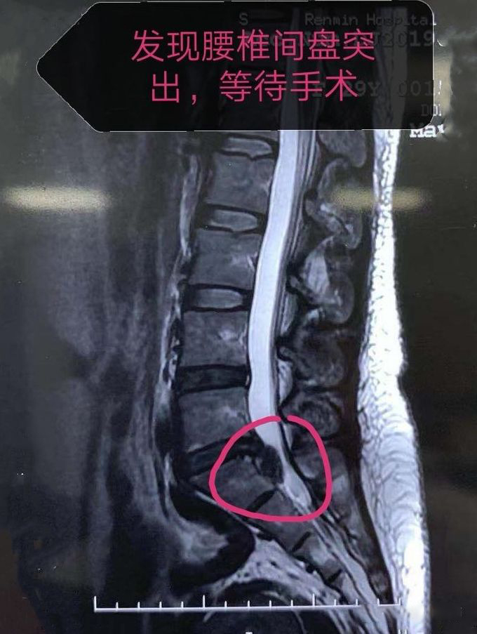 椎间盘突出病案分析,腰椎间盘突出做手术好久恢复正常