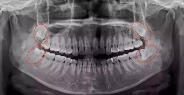 丽水小伙拔个牙住院三天、暴瘦10斤、脸肿成“方形”！这两类人赶紧检查一下