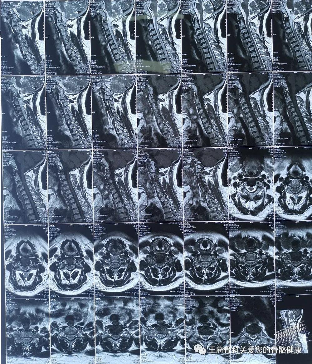 常见的五种颈椎病,颈椎病并发症最容易忽略的症状