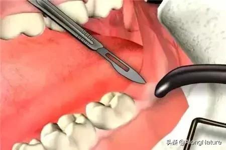 上火引起的牙疼牙龈肿痛怎么办,牙疼牙龈肿痛怎么办吃什么水果好