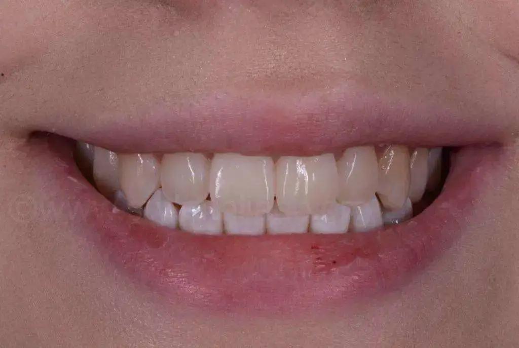 牙齿上出现白斑是怎么回事,牙齿上有白斑是什么原因