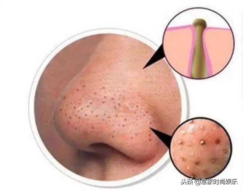 长痘的男生怎么祛痘,男生痘痘反复长不停如何正确祛痘