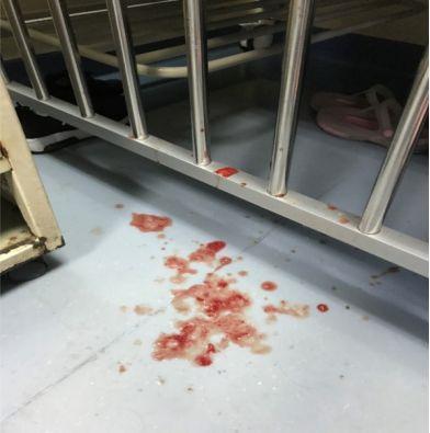 病例分析男性44岁反复咳嗽咳痰,长期咳嗽咳血是什么病的症状