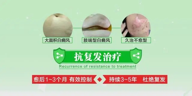 白癜风为什么治好了又复发,白癜风总是反复怎么办