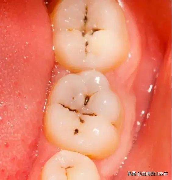 牙齿上有黑点可怕吗,牙齿上有小黑点原来这么可怕