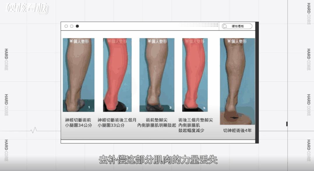 划开头皮、切断肌肉,为了美她们能做到什么程度?